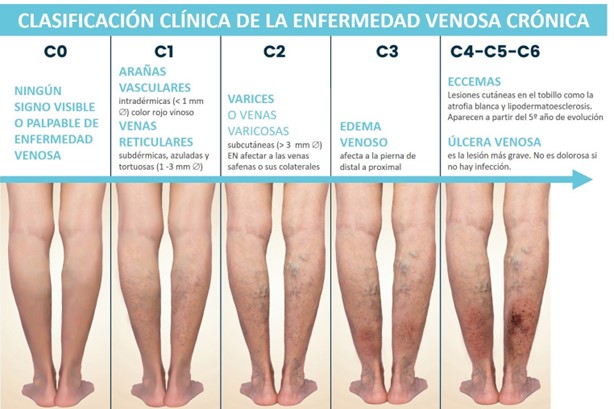 insuficiència venosa ortopèdia domènech